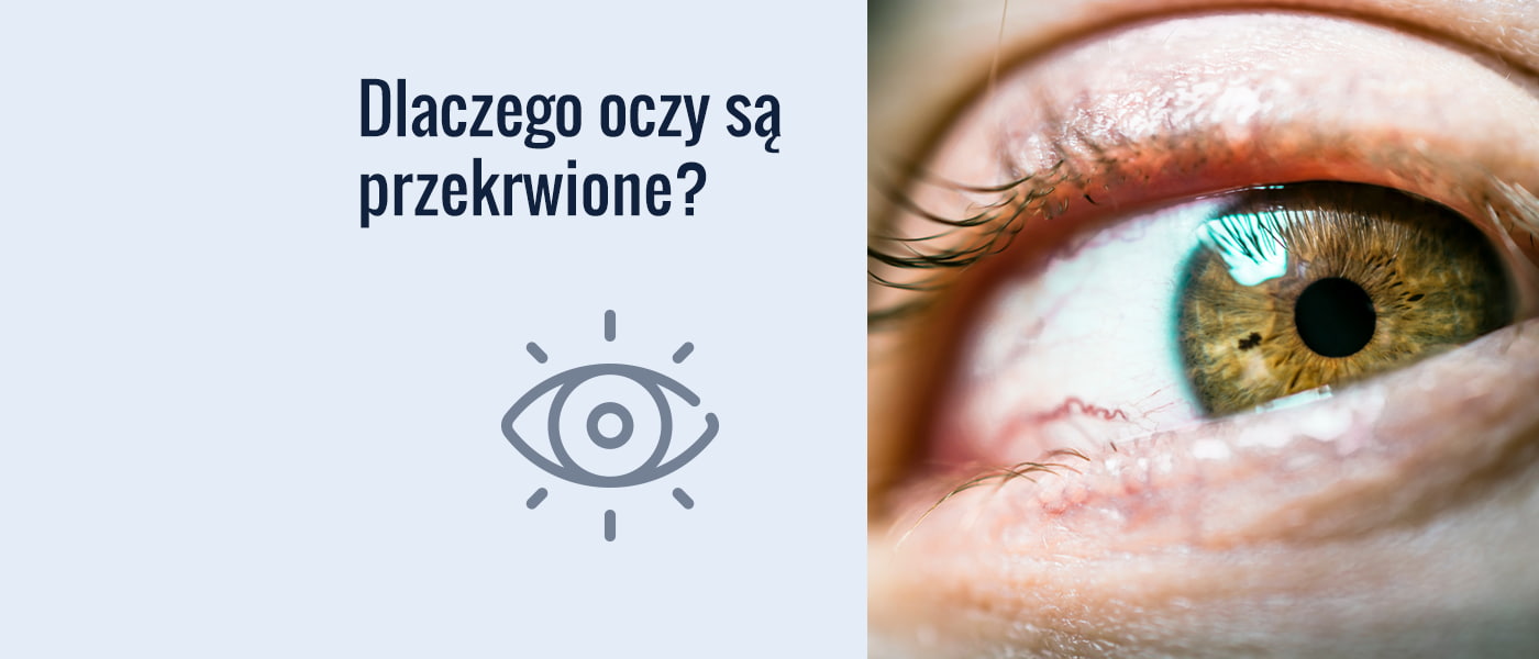 Dlaczego Oczy Są Przekrwione Badanie Wzroku Twoje Soczewki 1176
